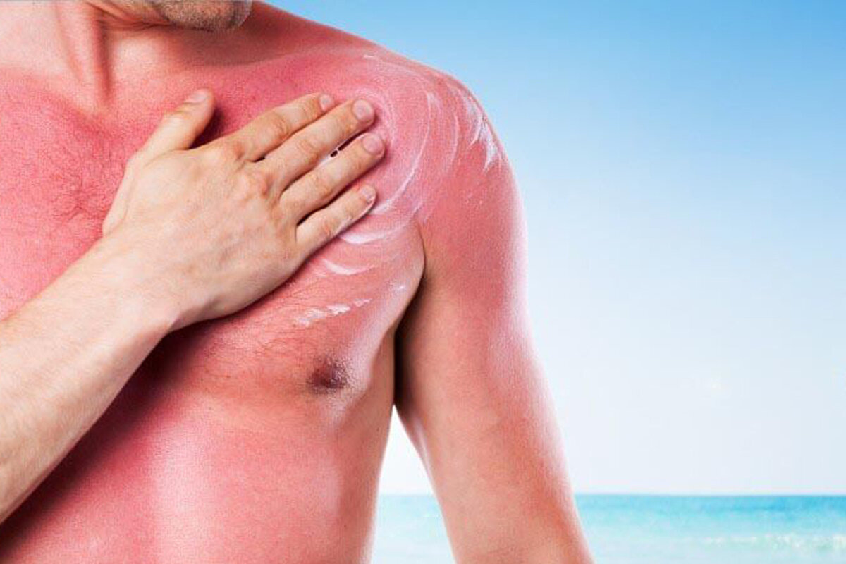 🌞🔥Как спасти и восстановить кожу после солнечного ожога в домашних  условиях? | Stoletnik.Ru | Дзен