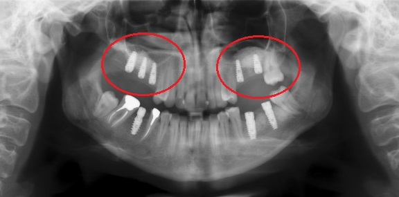 После закрытого синус-лифтинга установлены 5 имплантов, образовалась плотная кость. Фото с сайта https://akademstom.ru