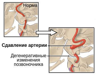 Синдром позвоночной артерии что это такое