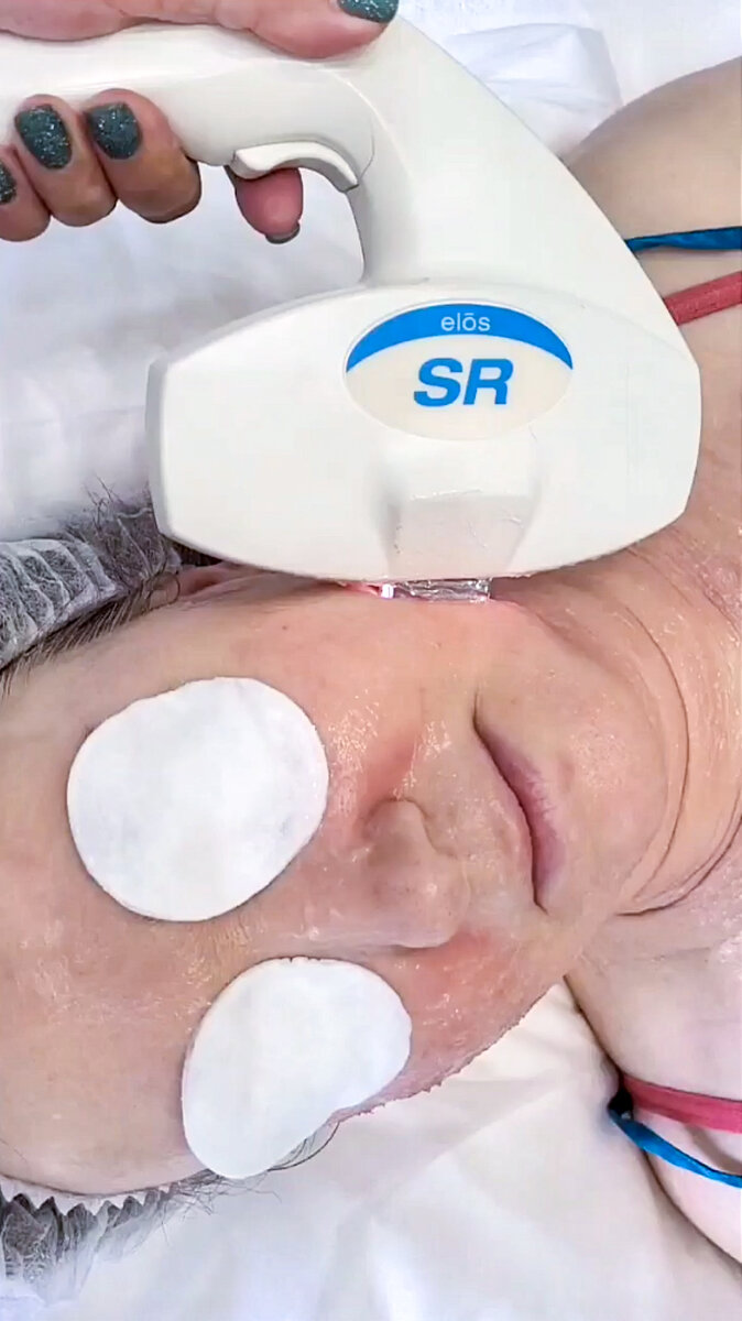 Наши специалисты подберут вам пилинг или процедуру, например, на аппарате Syneron e-light. 