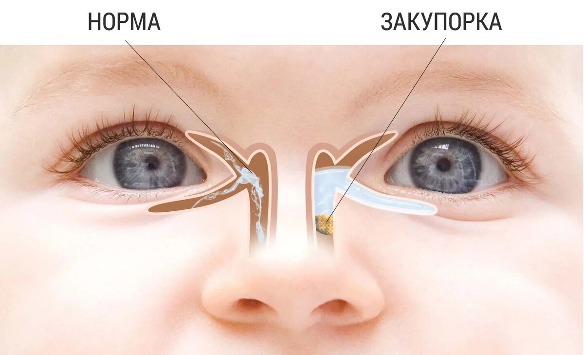 У грудничка гноится глаз: чем лечить?