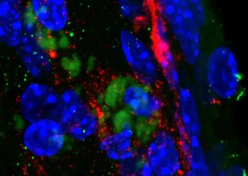    Бактерии Chlamydia pneumoniae (зеленые) в головном мозге мыши, окруженные бета-амилоидным белком (красный)
