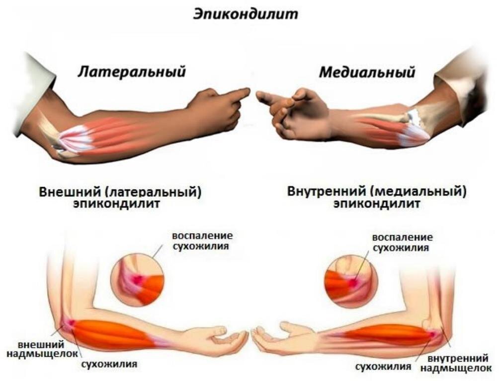 Эпикондилит плечевой кости. Внешний надмыщелок локтевого сустава. Латеральный надмыщелок локтевого сустава. Латеральный эпикондилит сухожилие. Медиальный эпикондилит сухожилия.