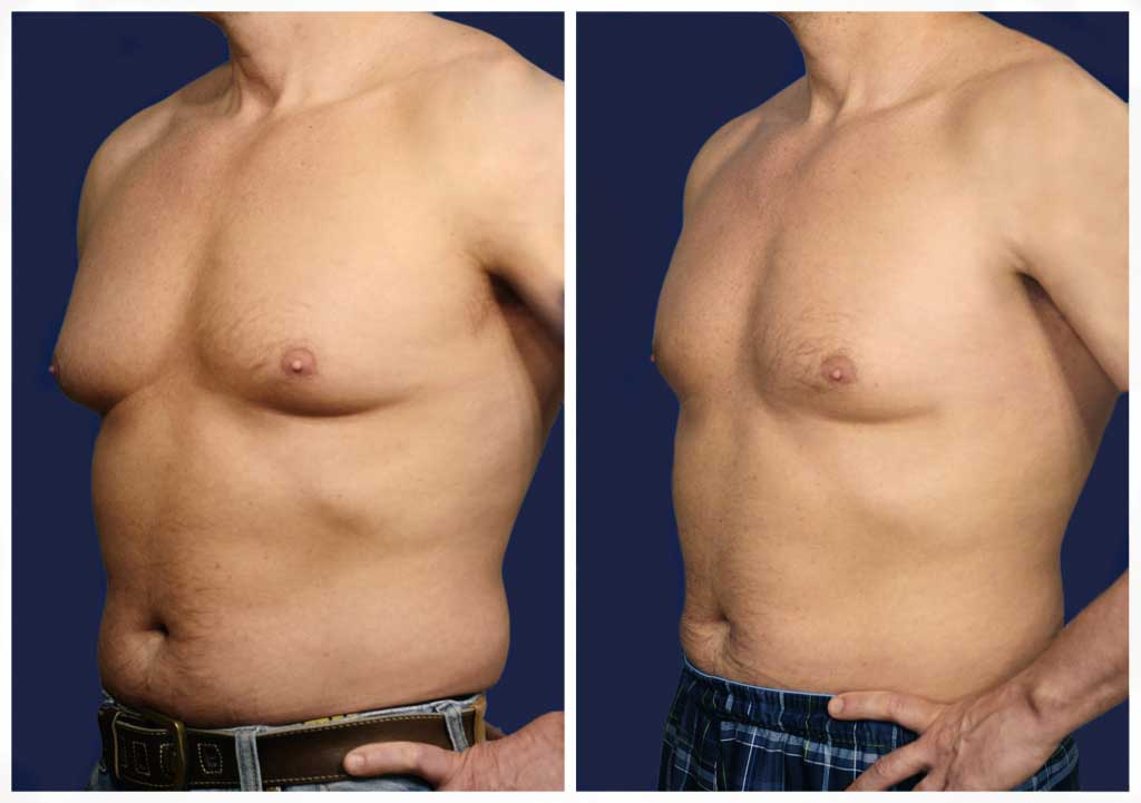 гинекомастия у мужчин операция. фиброзная гинекомастия. гинекомастия, мастодиния. пролактинова гинекомастия. фиброзная гинекомастия.