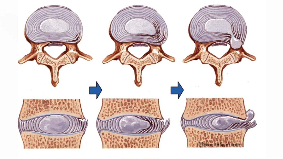 Выбухание межпозвоночного диска