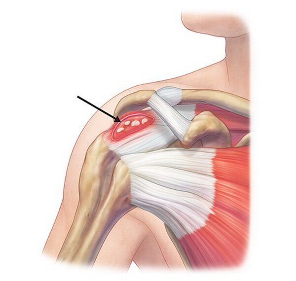 "соль" в мышцах.