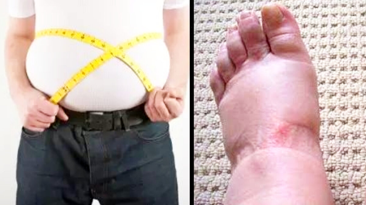 Изначально стоит сказать о том, что в случае накопления воды в организме происходит повышение артериального давления. Как следствие, возникает гипертрофия левого желудочка. В результате, вы не просто будете знать о том, как быть в случае отеков, но и убережете себя от риска возникновения инфаркта, ишемической болезни.