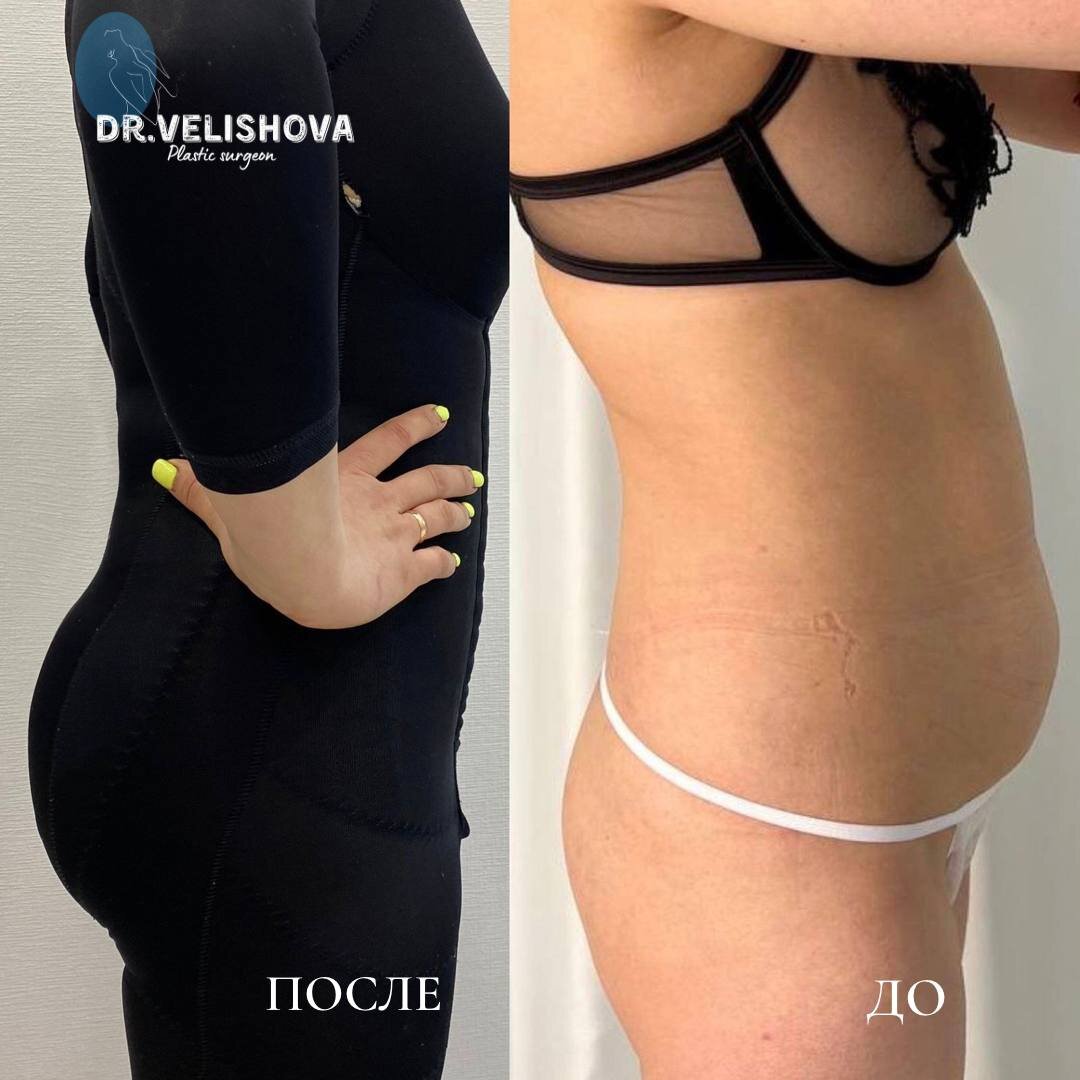 фото сразу после процедуры