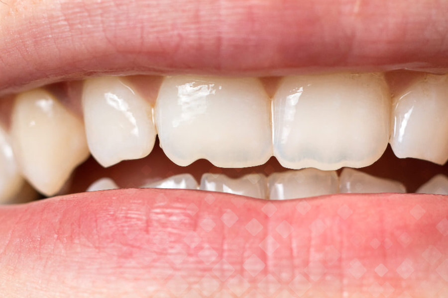 Почему зубы становятся кривыми?