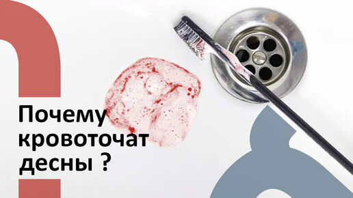 Почему кровоточат десны?