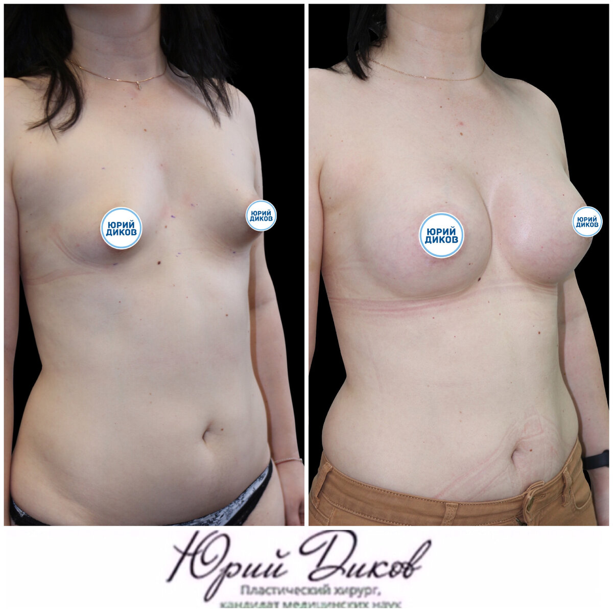 тубулярная форма груди у женщин фото 25