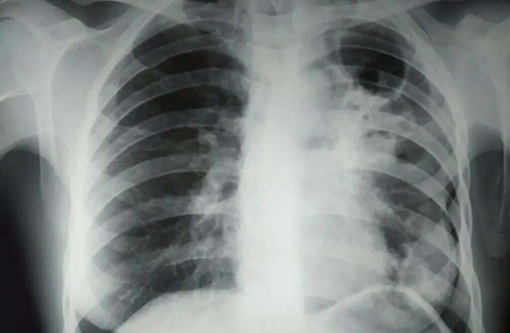    Туберкулез обычно обнаруживают с помощью флюорографии, но на самом деле палочка Коха может присутствовать в нашем организме и в скрытой форме / © ovsalud.org