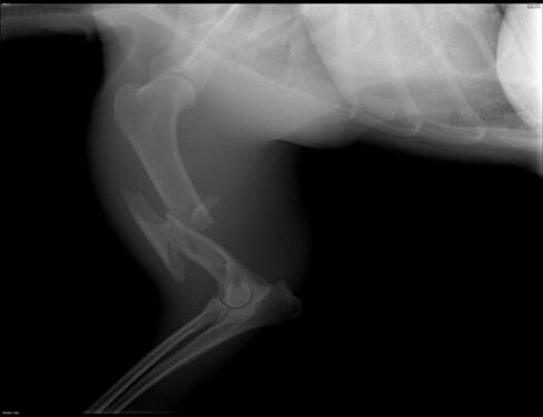 Сложный спиралевидный оскольчатый перелом диафиза плечевой кости