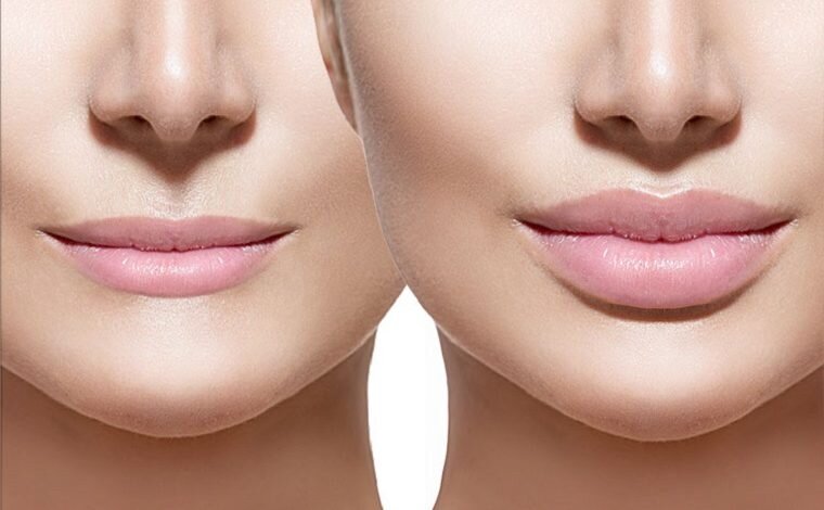 Lip Filler Swelling Stages: What Is Normal