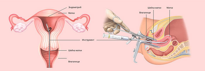 Процедура необходима при выявлении различных патологических изменений на поверхности матки или в толще ткани во время прохождения гинекологического осмотра либо аппаратной диагностики.