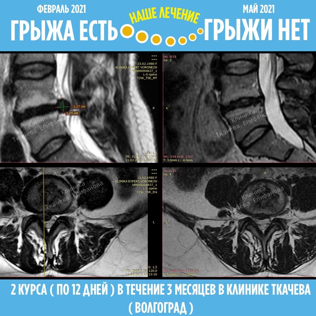 Лечение межпозвоночной грыжи в Волгограде
