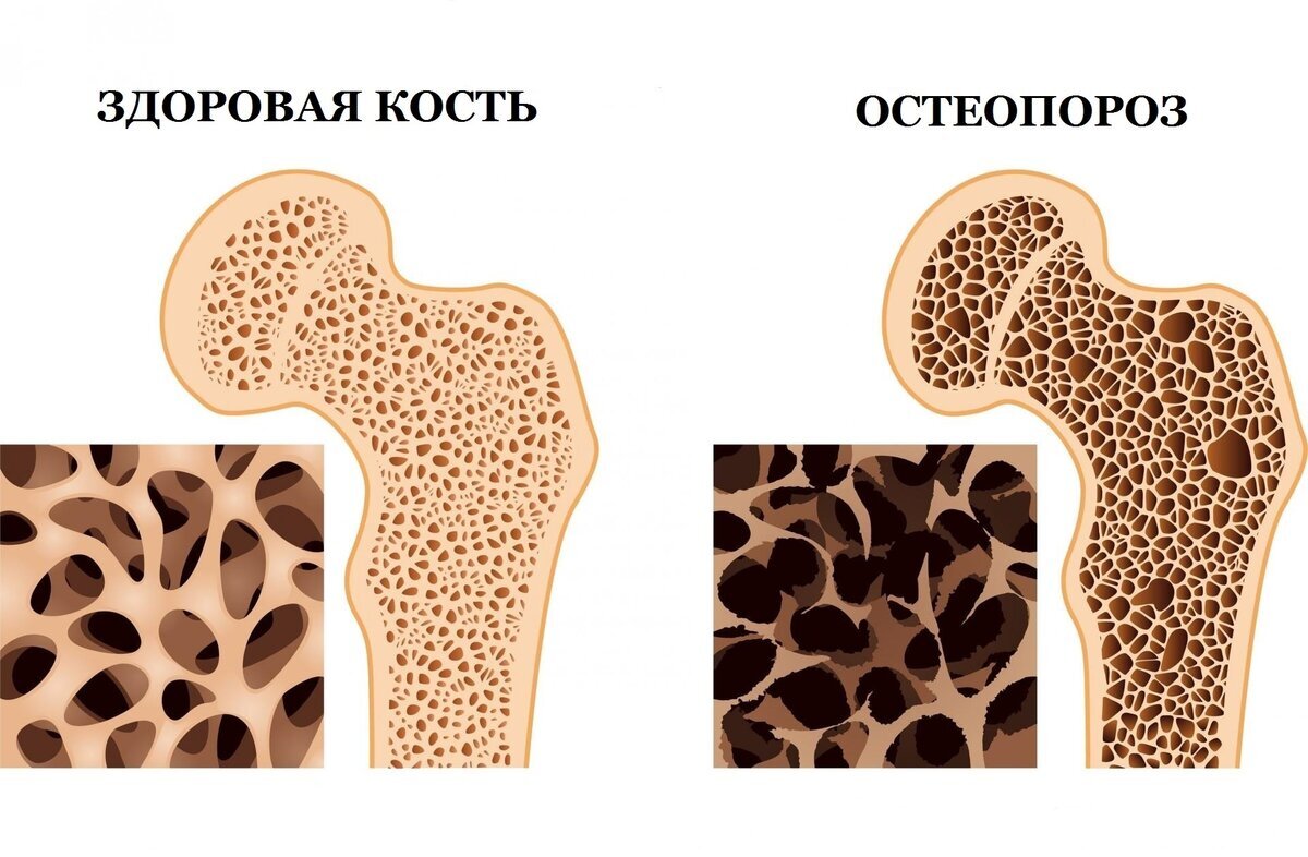 Здоровая кость и остеопороз