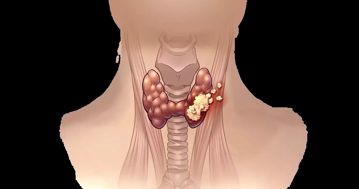 Рак щитовидной железы - злокачественное новообразование, из клеток железистой ткани щитовидной железы. 