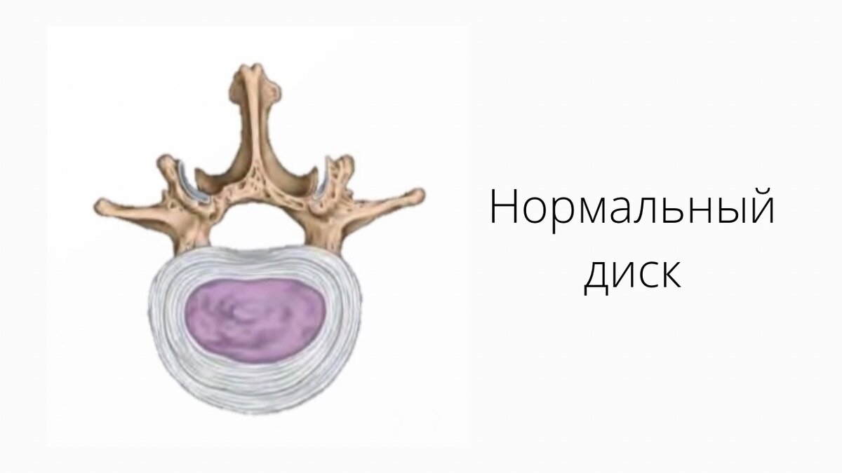 Какие движения потенциально опасно делать при остеохондрозе | ПИЛАТЕС ДЛЯ  ЖИЗНИ | Дзен