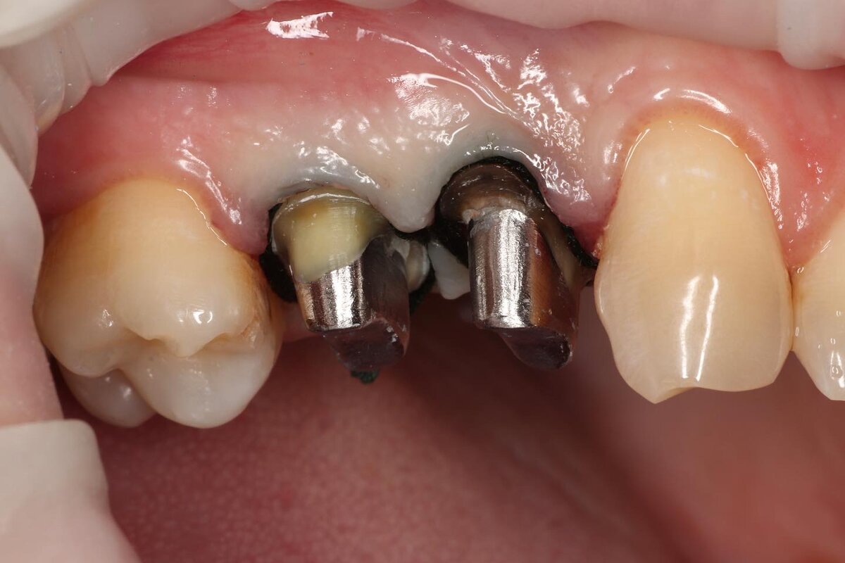 Культевые вкладки в полости рта 