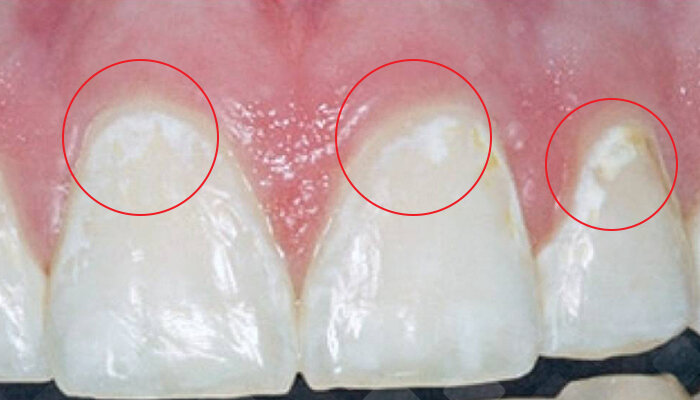 Белые участки деминерализации на зубах чаще появляются в тех местах, где больше всего налета. Например, вдоль десны, в межзубных промежутках. Фото: Яндекс.Картинки.