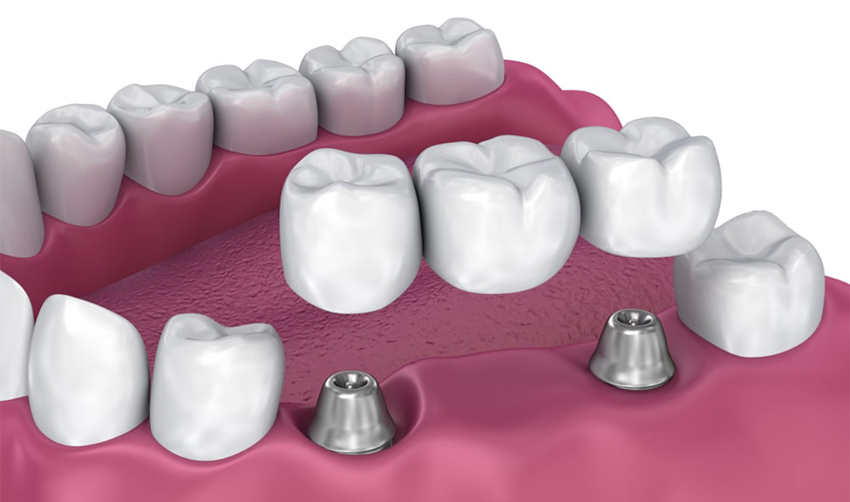 Мостовидный протез на имплантах. Фото взято с сайта https://akademstom.ru/articles/mostovidnye-protezy-na-zuby/