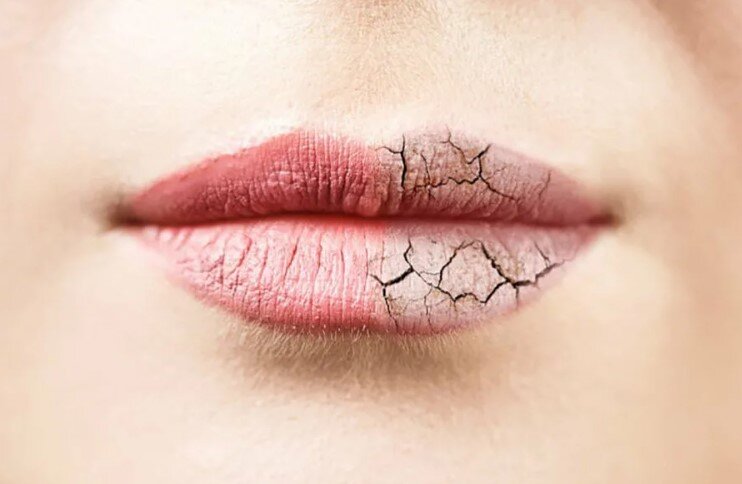 Хейлит. Причины, виды, лечение