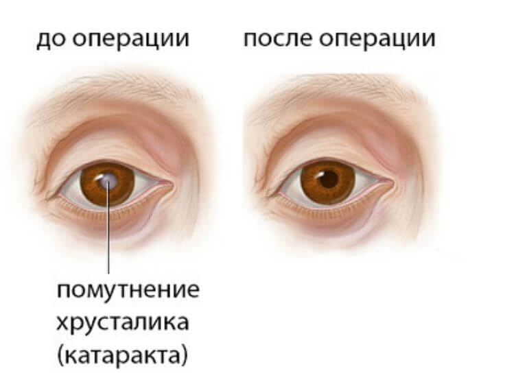 Катаракт после операции. Операция на хрусталик глаза. Глаз после операции катаракта. Операция на катаракту глаза.