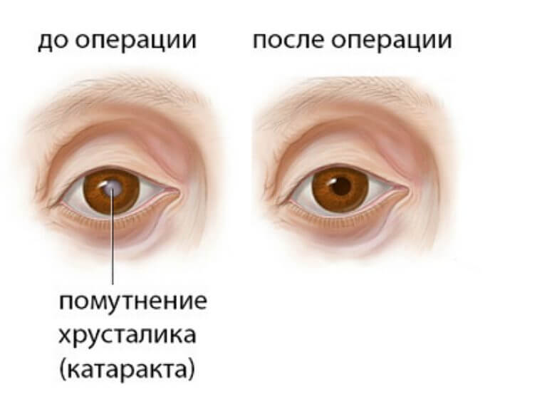 Действие после операции катаракта