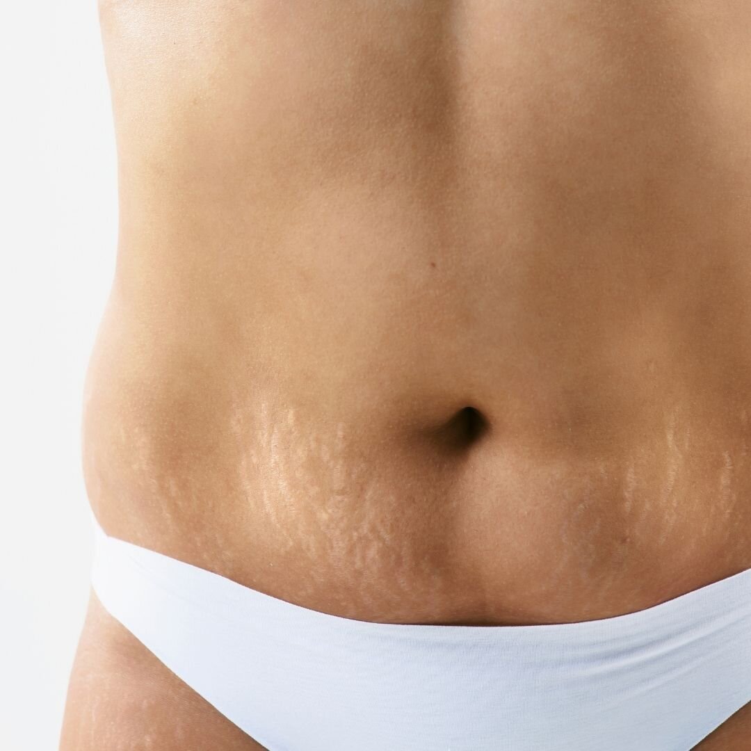 Для  живота - при снижении и нескольких месяцев стабилизации веса