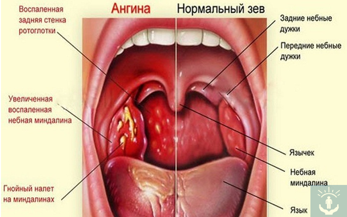 Папиллома задней нёбной дужки, выявленная после гастроскопии