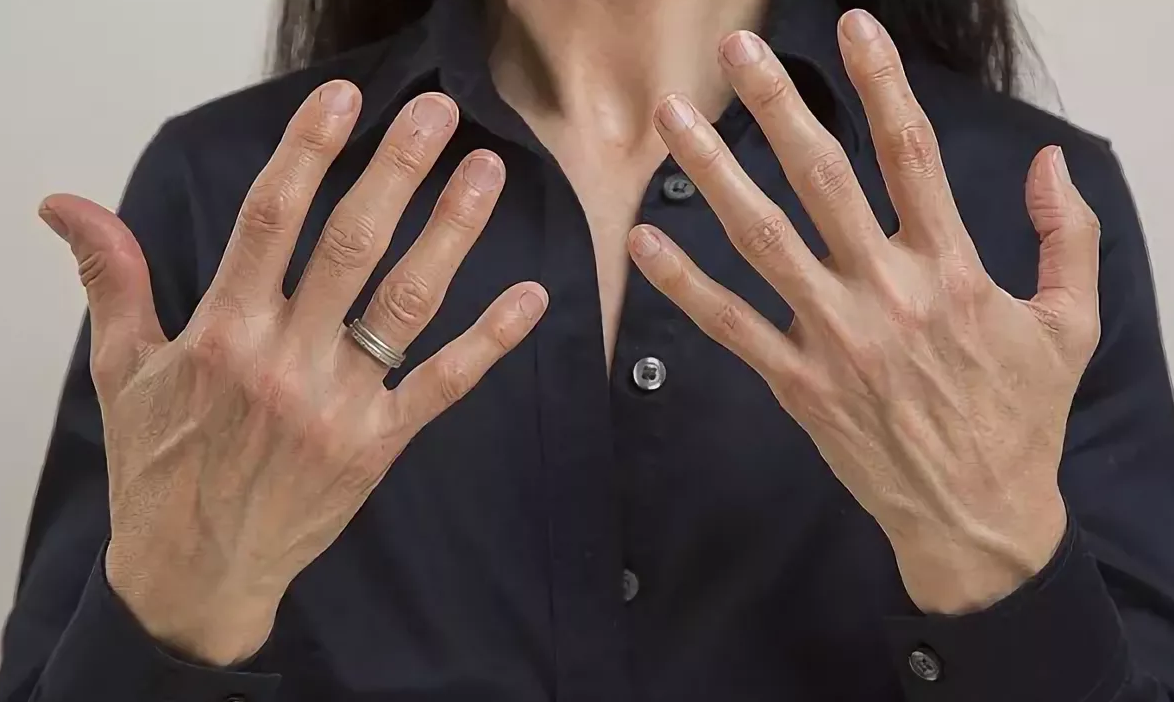 Женщины без пальцев на руках. Некрасивые женские руки. Некрасивые женские пальцы на руках. Не красивые женские пальцы на руке.