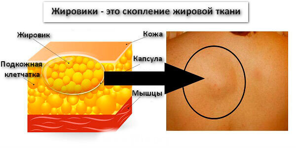 Липома (жировик)