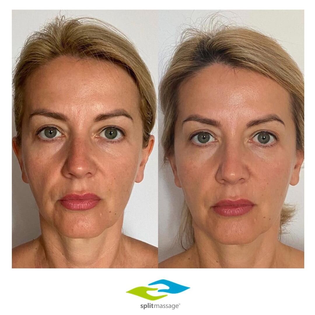Результаты процедуры Сплитмассаж