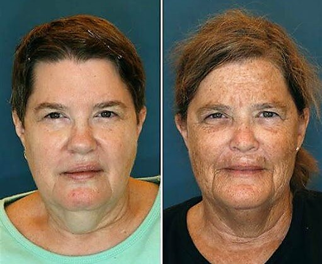 Сестры-близнецы. Одна (слева) всегда пользовалась защитой от солнца, вторая – нет.