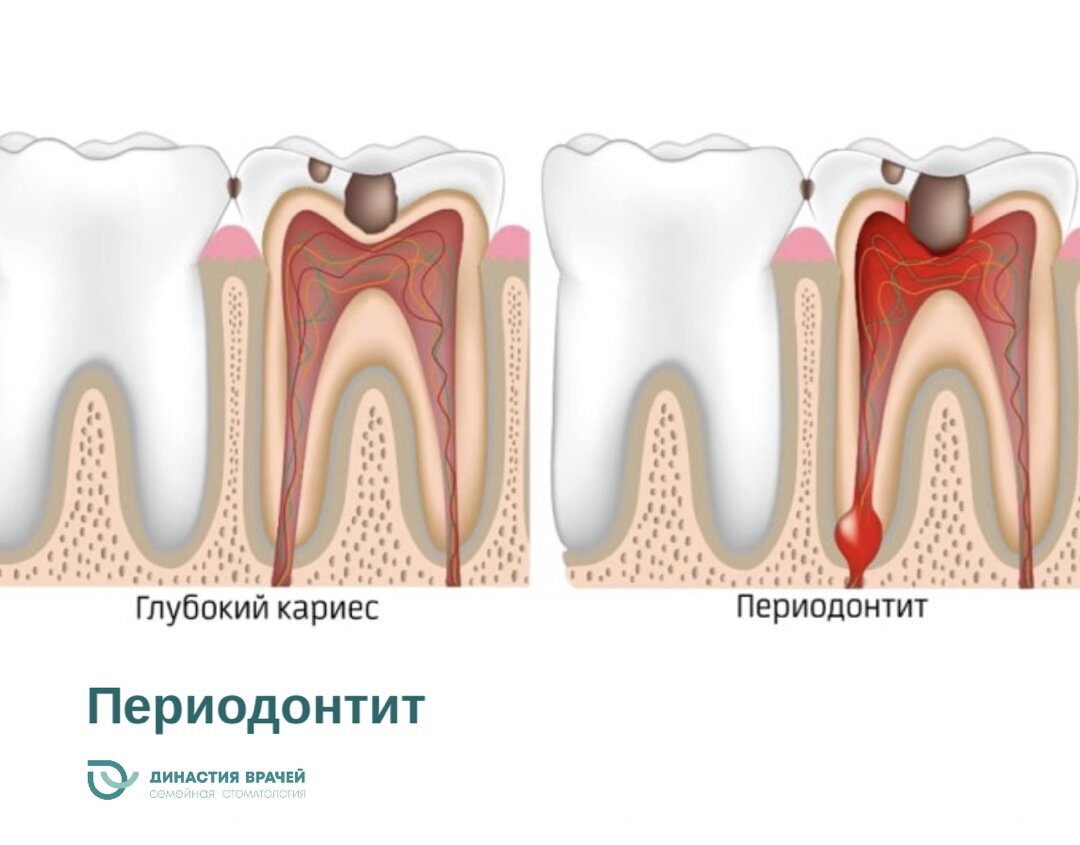 Периодонтит 