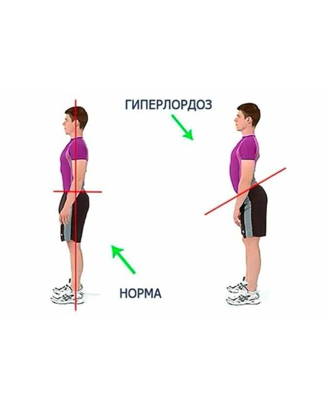 Упражнения от гиперлордоза в пояснице у женщин. Гиперлордоз. Гиперлордоз поясничного. Гиперлордоз поясничного отдела позвоночника. Лордоз и гиперлордоз.