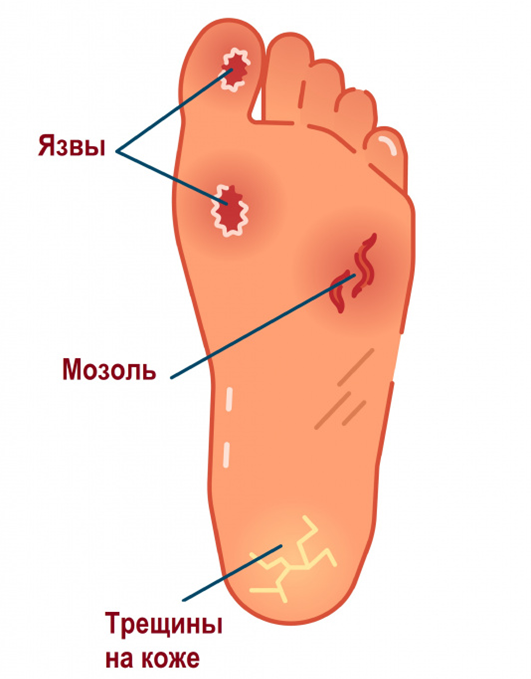 Трофическая язва: причины, симптомы, лечение