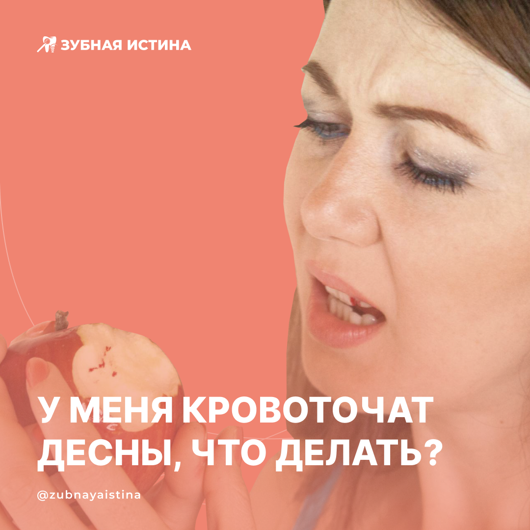 Кровоточивость дёсен — это один из симптомов их воспаления