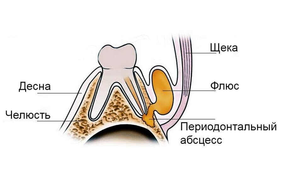 Абсцесс зуба: симптомы и методы лечения
