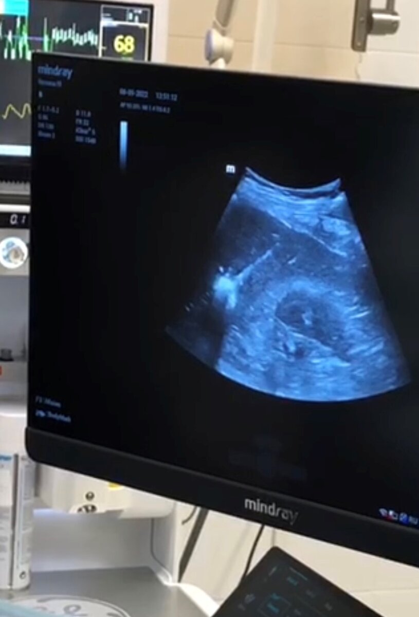 На экране УЗИ-аппарата запечатлен процесс разрушения метастаза в печени во время МВА