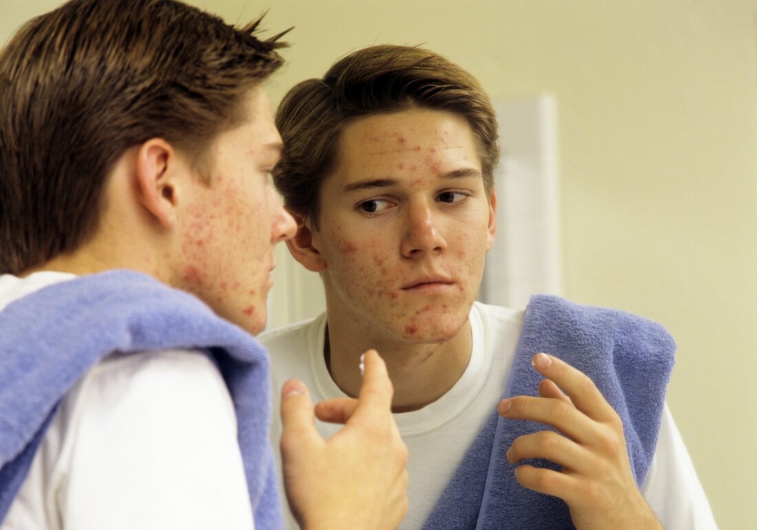Чистка лица у подростков используется в комплексной терапии лечения акне. Процедура по очищению кожи убирает открытые/закрытые комедоны, снижает риск воспалений.