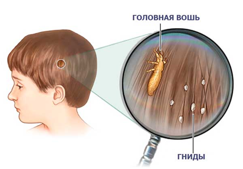 Педикулез симптомы. Выявление педикулеза у детей.