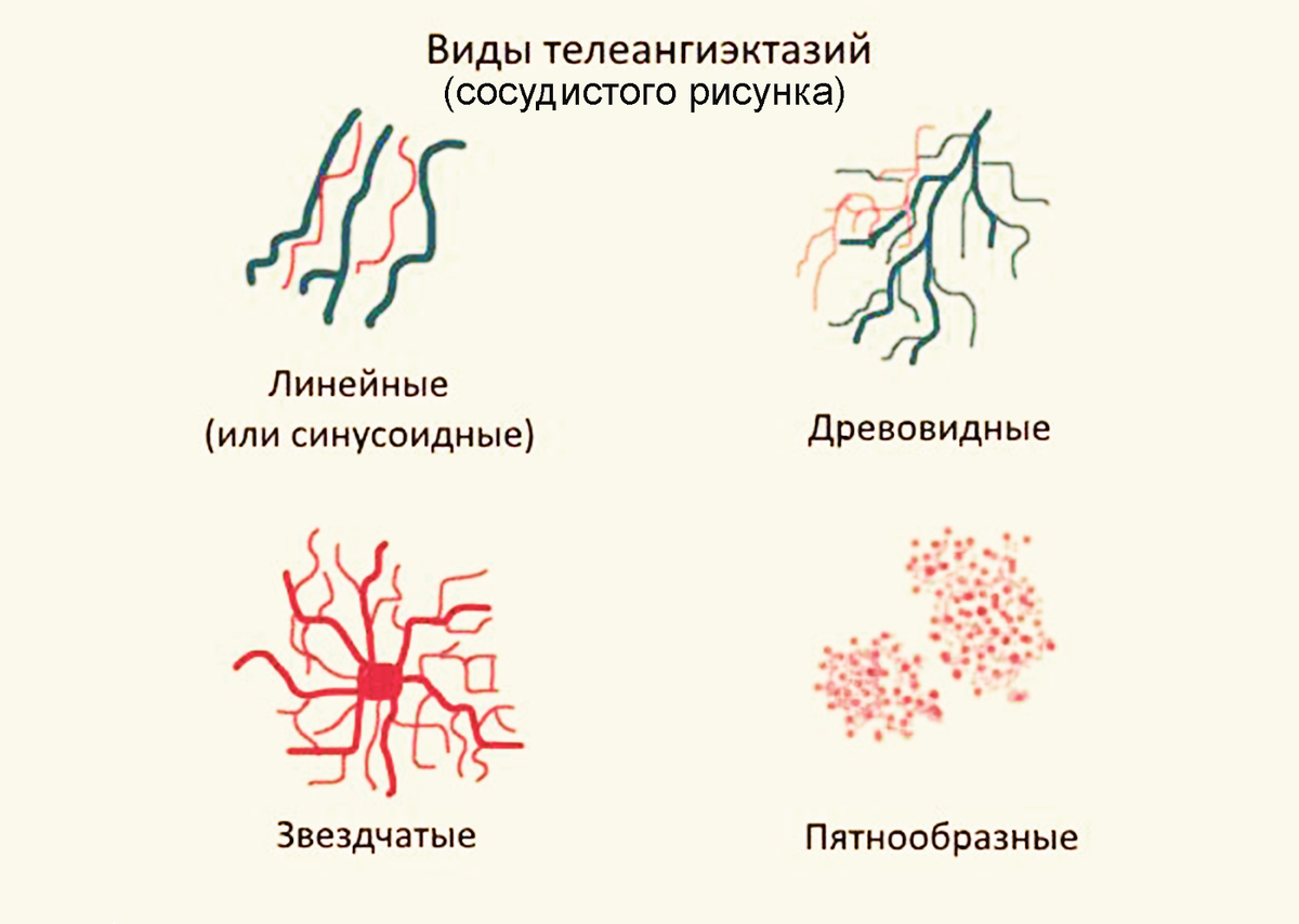 Im ersten Stadium der CVI werden solche Gefäßzeichnungen auf den Beinen sichtbar. Foto: probolezny.ru