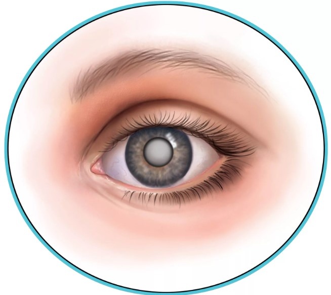 Как вылечить катаракту?