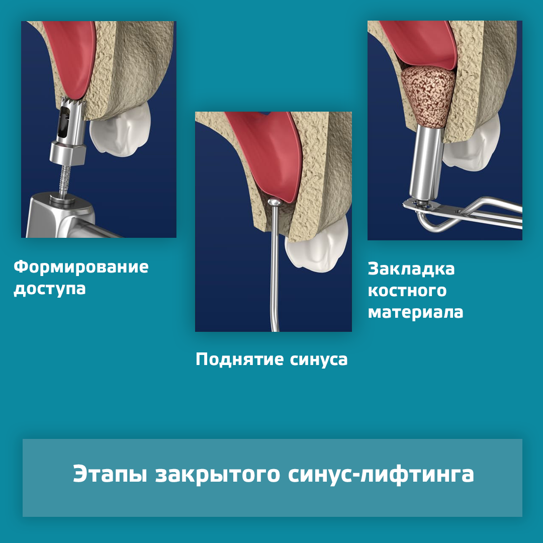 Синус лифтинг схема