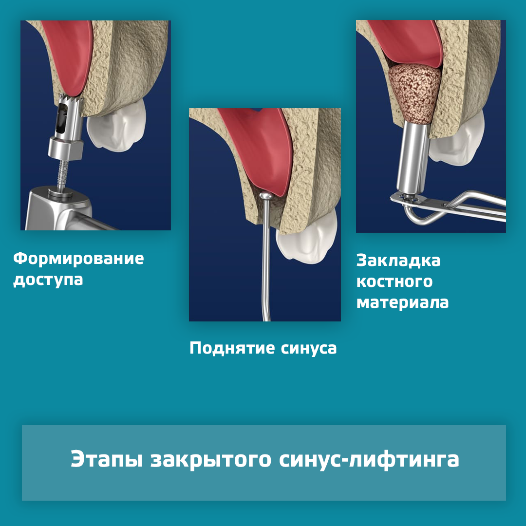 Синус лифтинг в стоматологии что это. Закрытый синус лифтинг что такое в стоматологии. Синус лифтинг в стоматологии что такое. Синус лифтинг в стоматологии методика проведения.