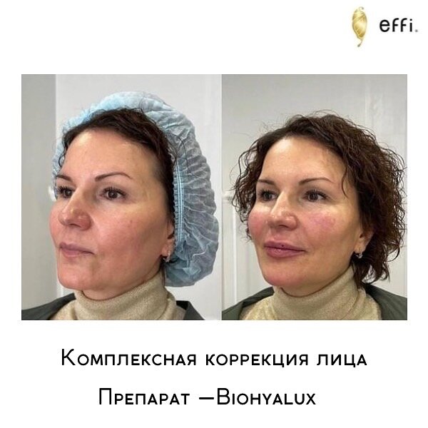 Клиника косметологии и пластической хирургии effi. Красноярск. Препарат Biohyalux Deep Dermis