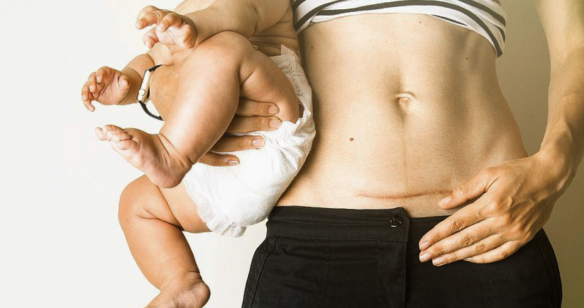 Предпочла довериться решению специалистов о необходимости кесарева сечения