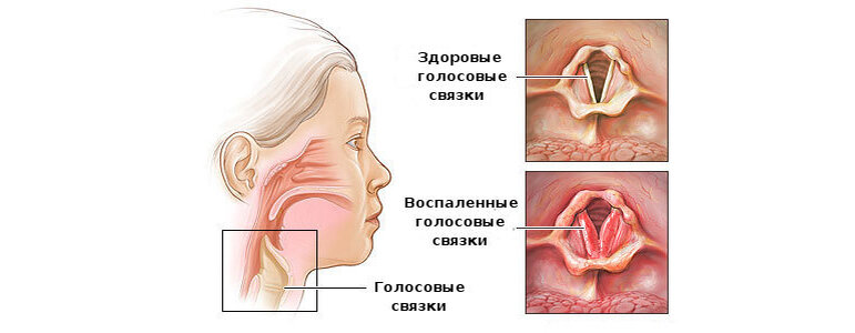 Заболевания горла и гортани: симптомы и лечение